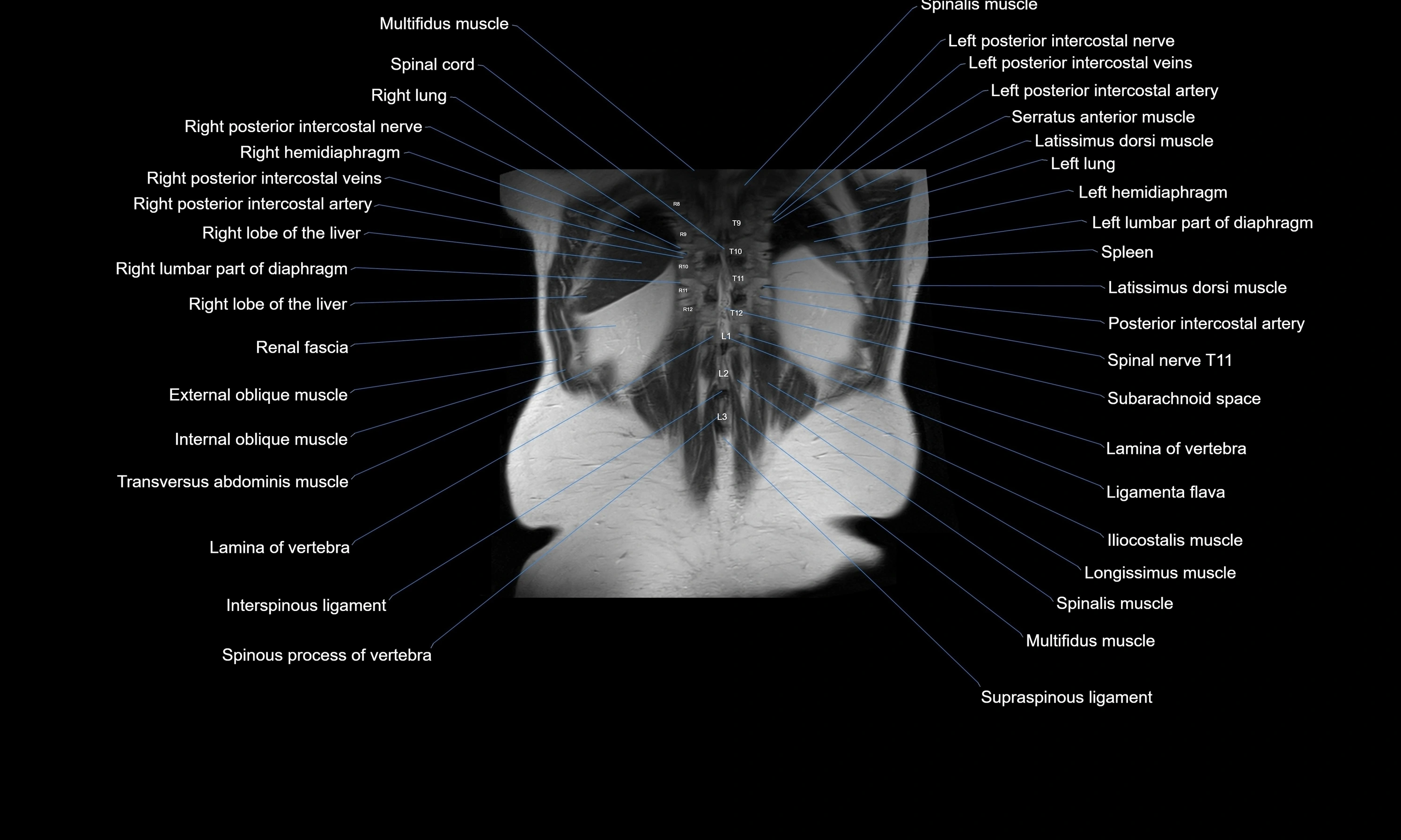 MRI Abdomen axial cross sectional anatomy radiology  image-img-00001-00051.webp
